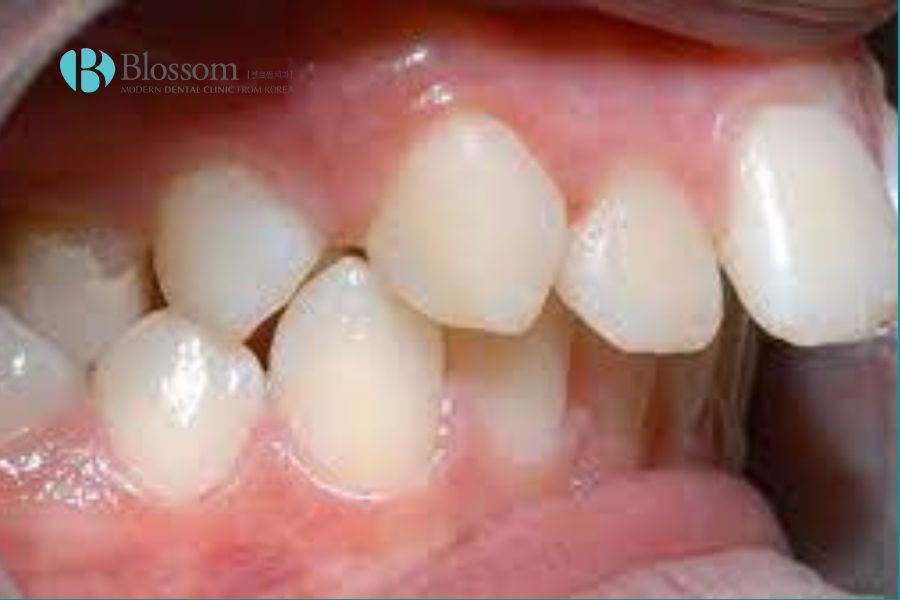 Dạng vẩu kết hợp là tình trạng kết hợp giữa răng vẩu hàm trên và vẩu hàm dưới.