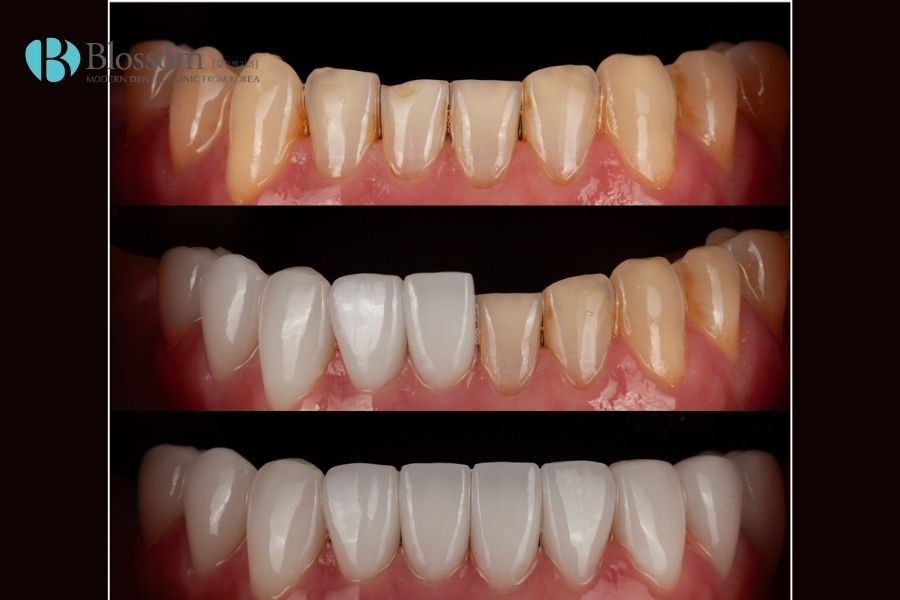Đắp răng sứ không mài Lamifilm được thực hiện nhanh chóng, an toàn tại Nha Khoa Blossom
