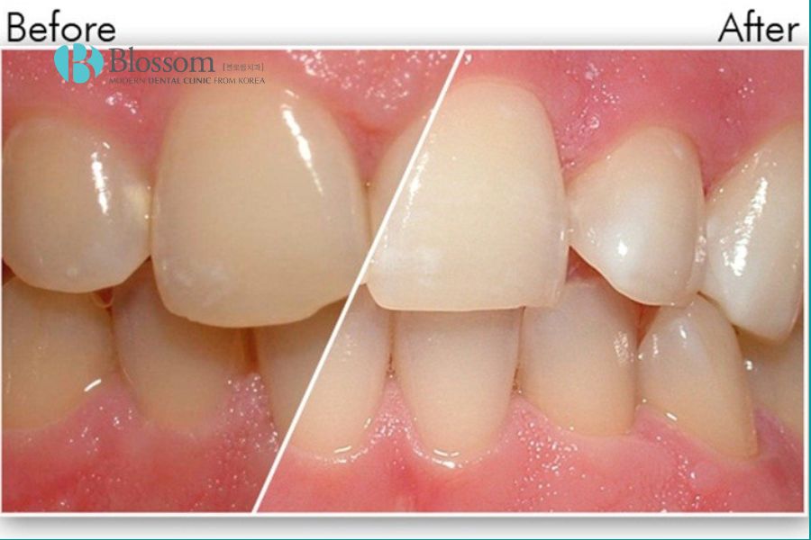 Dấu hiệu phổ biến nhất của răng nhiễm Fluor là các mảng trắng đục nhỏ xuất hiện.