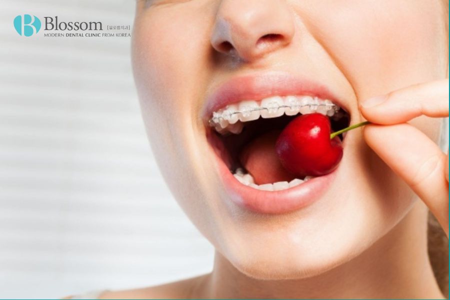 Để đảm bảo hiệu quả chỉnh nha và sức khỏe răng miệng tốt nhất, bạn cần lưu ý một số cách ăn uống.