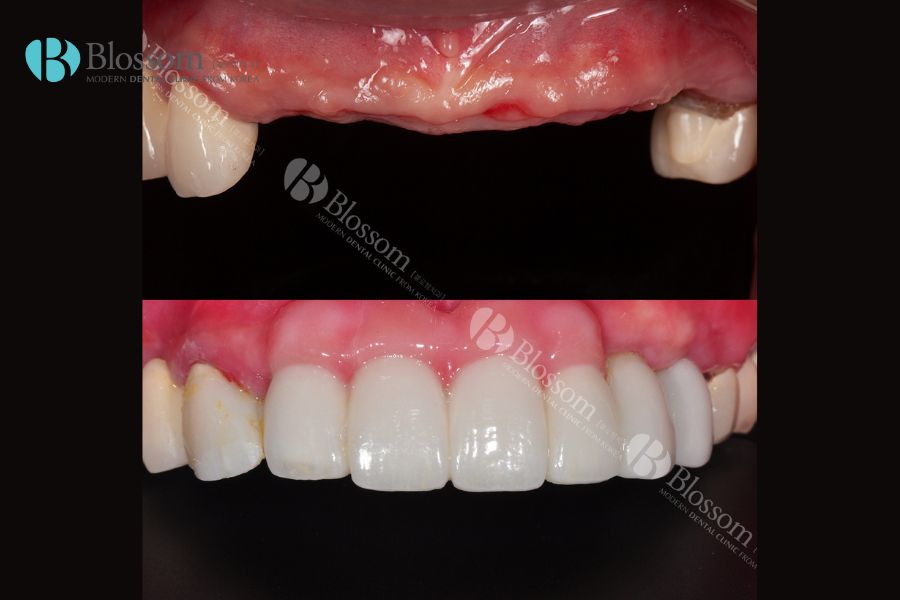 Đơn vị cung cấp dịch vụ trồng răng Implant an toàn và chất lượng - Nha Khoa Blossom