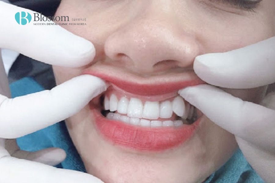Dưới góc độ nha khoa, răng khểnh không thực sự là trạng thái lý tưởng.