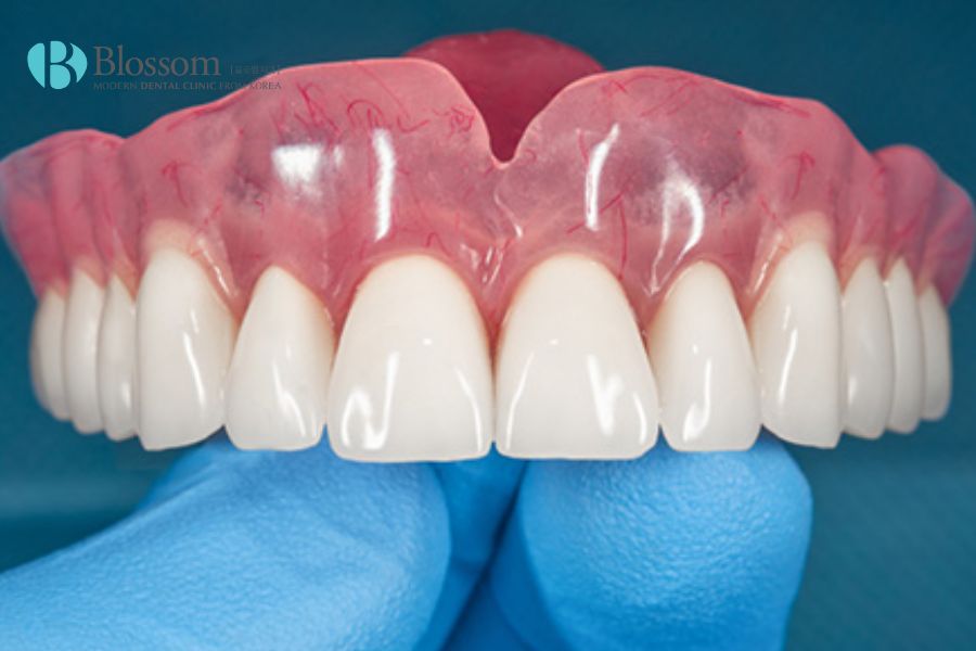 Giá trồng răng giả tháo lắp có sự chênh lệch nhất định dựa trên loại răng giả lựa chọn