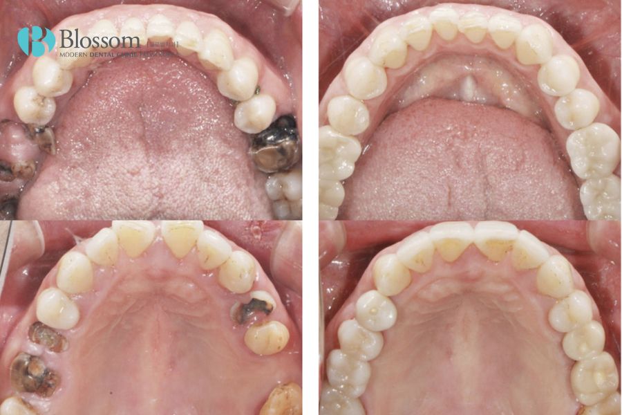Giải quyết vấn đề mất răng hàm lâu năm nhờ phương pháp cấy ghép Implant an toàn tại Nha Khoa Blossom