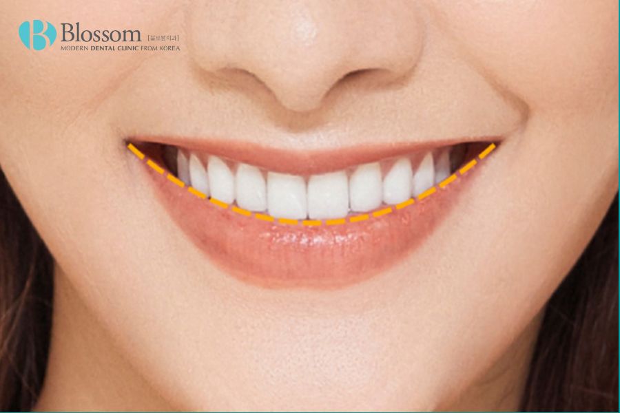 Hàm răng đều đặn, thẳng hàng là yếu tố quan trọng nhất tạo nên nụ cười đẹp.