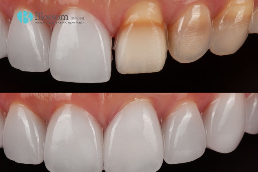 Hàm răng trước và sau khi dán sứ Lamifilm có sự thay đổi rõ rệt.