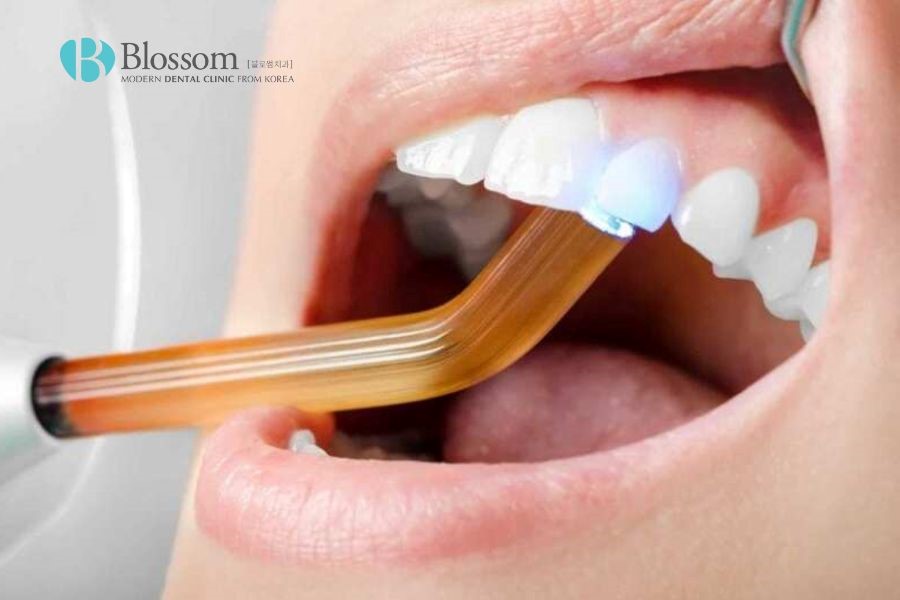 Hàn/trám răng giúp xử lý tình trạng răng thưa ở cấp độ nhẹ