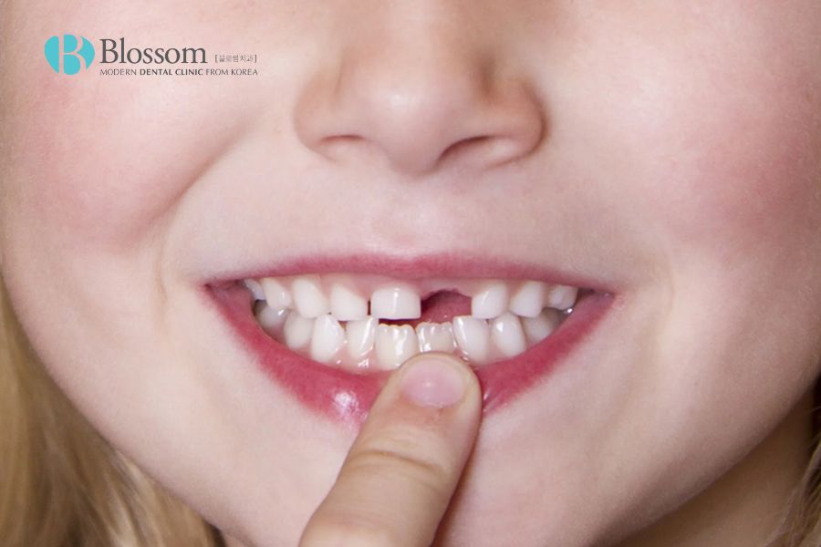 Hiện tượng mất răng khi còn nhỏ nếu không được nắn chỉnh sớm dễ gây nên tình trạng răng cửa mọc lệch.
