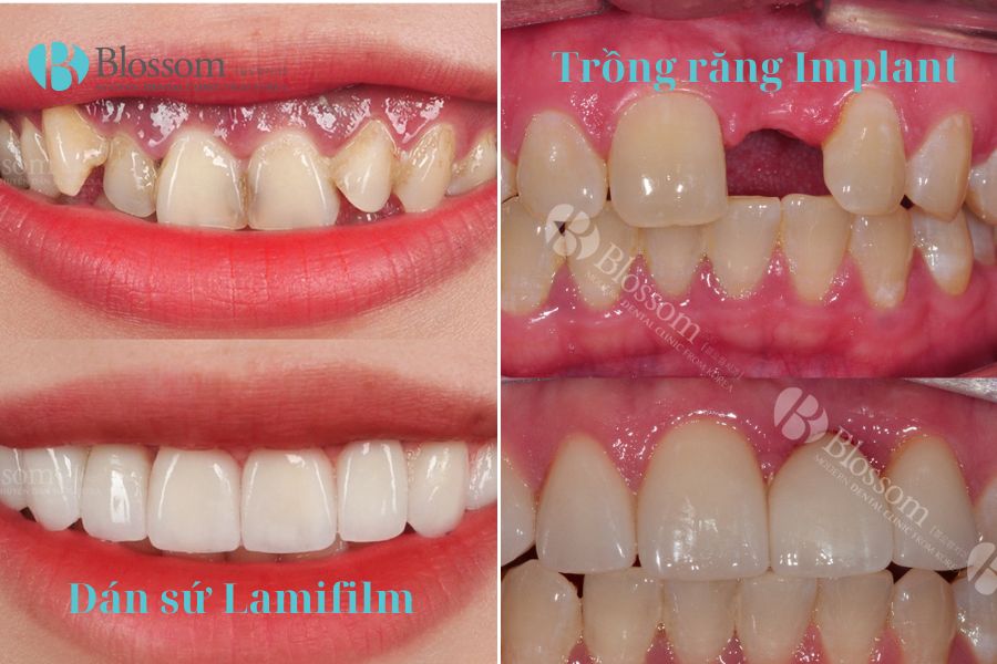 Hình ảnh thực tế khách hàng tại Nha Khoa Blossom thực hiện dán sứ Lamfilm và trồng răng Implant