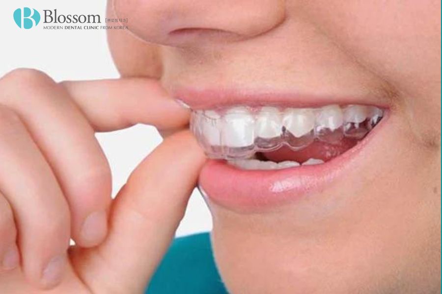 Khay niềng có thể tháo lắp dễ dàng, giúp bạn dễ dàng vệ sinh răng miệng.