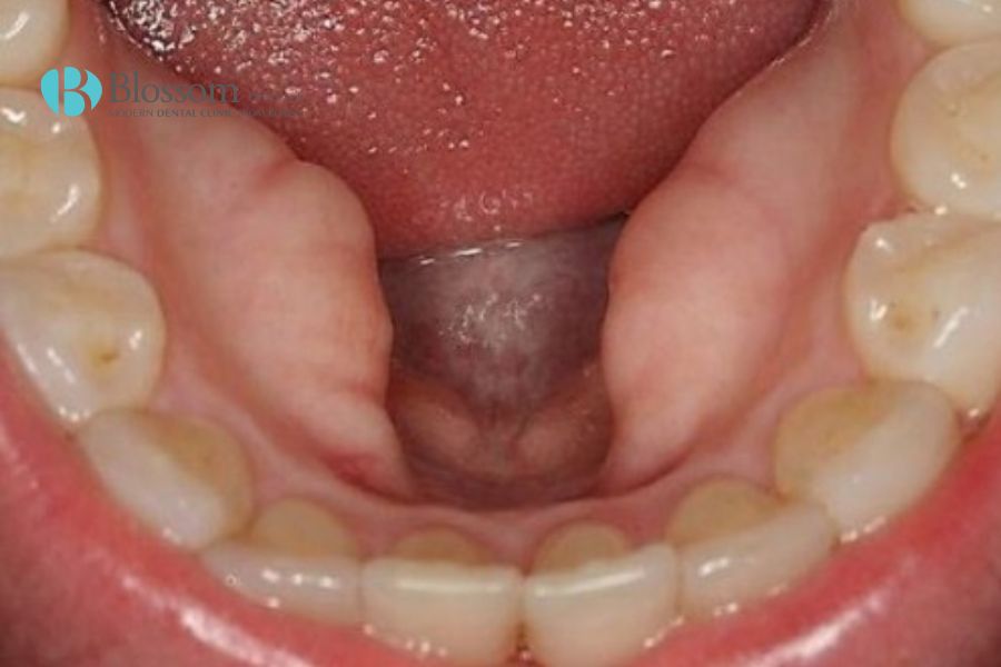Khung hàm nhỏ hẹp có thể là nguyên nhân khiến răng mọc xô lệch.