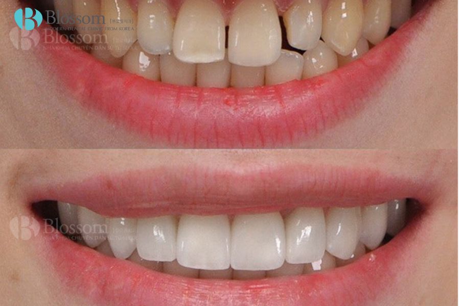 Lamifilm là công nghệ điều trị mòn men răng số 1 hiện nay.