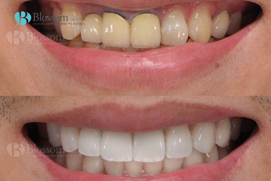 Lamifilm là công nghệ phục hình thẩm mỹ răng nha khoa tiên tiến số 1 hiện nay.