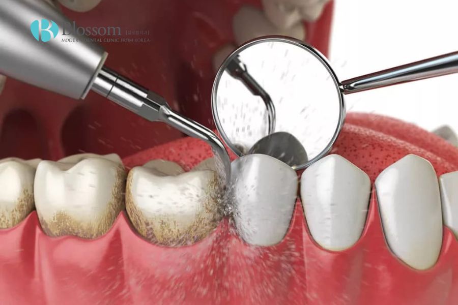 Lấy cao răng giúp loại bỏ mảng bám lâu ngày trên răng.