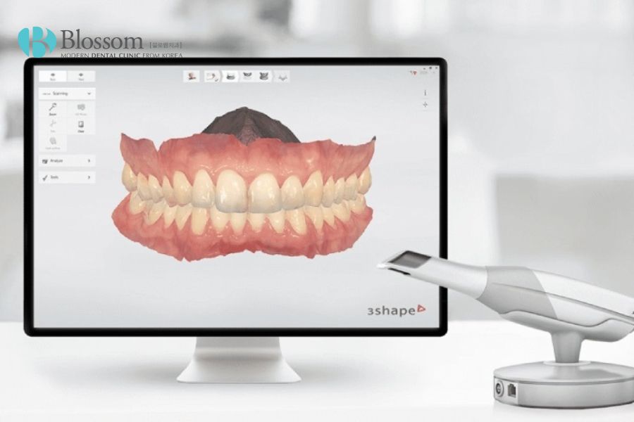Lấy dấu hàm bằng máy quét 3D để tiến hành thiết kế răng sứ