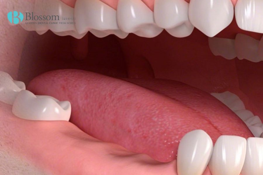 Lưu ý khi điều trị mất răng hàm lâu năm là mục tiêu phục hồi chức năng ăn nhai và phát âm