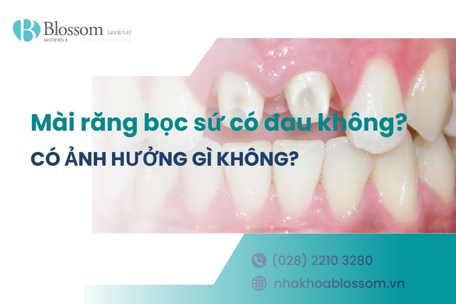 Mài răng bọc sứ có đau không? Có ảnh hưởng gì không?