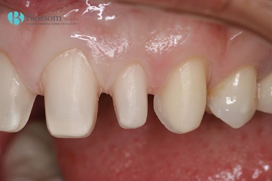 Mài răng bọc sứ tác động đến lớp men răng bên ngoài, không xâm lấn tủy hoặc ngà răng