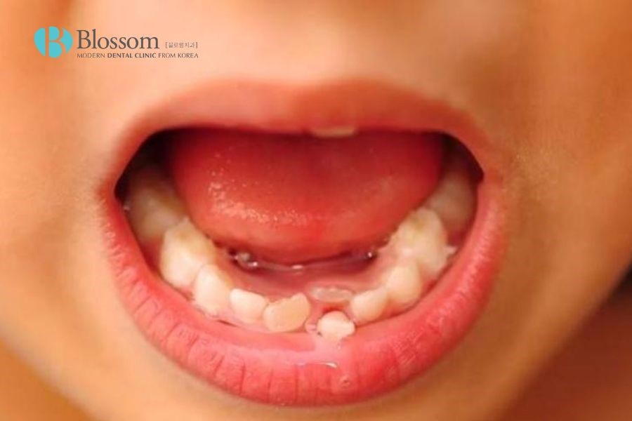 Mầm răng mọc lệch dễ gây nên tình trạng răng xô lệch từ nhỏ.