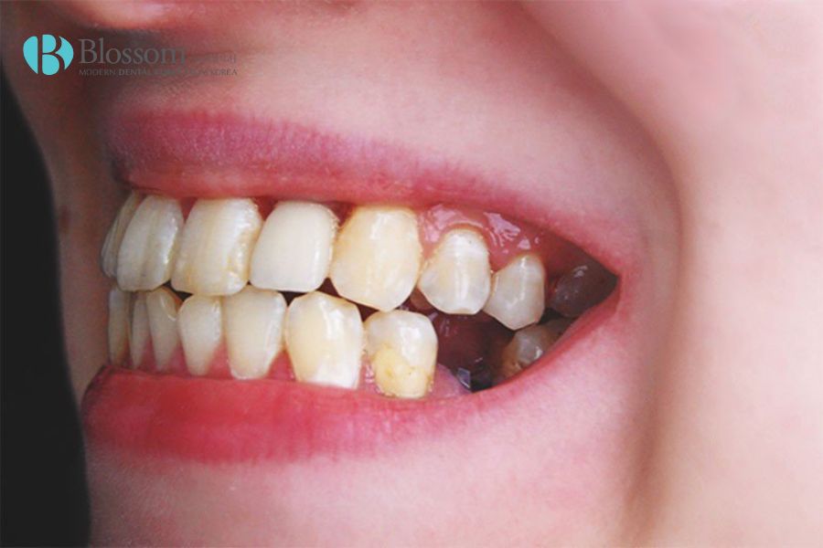 Mất răng hàm lâu năm dẫn đến răng kế cận xuất hiện tình trạng xô lệch, gây mất thẩm mỹ