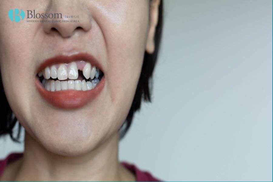 Mất răng là một trong những nguyên nhân quan trọng dẫn đến tình trạng móm răng.