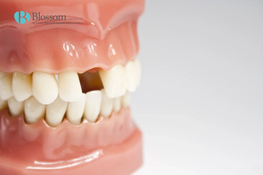 Mất răng là nguyên nhân chính dẫn đến hiện tượng răng xô lệch.