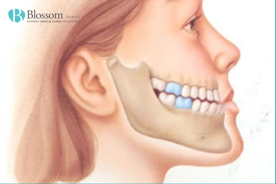 Móm do cả răng và xương hàm sai lệch khiến cấu trúc xương hàm và răng đều phát triển bất thường.