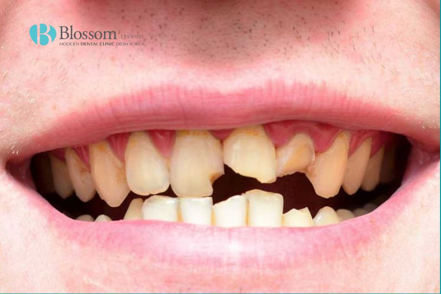 Móm do răng sai lệch là tình trạng mất cân bằng cấu trúc giữa hai hàm.