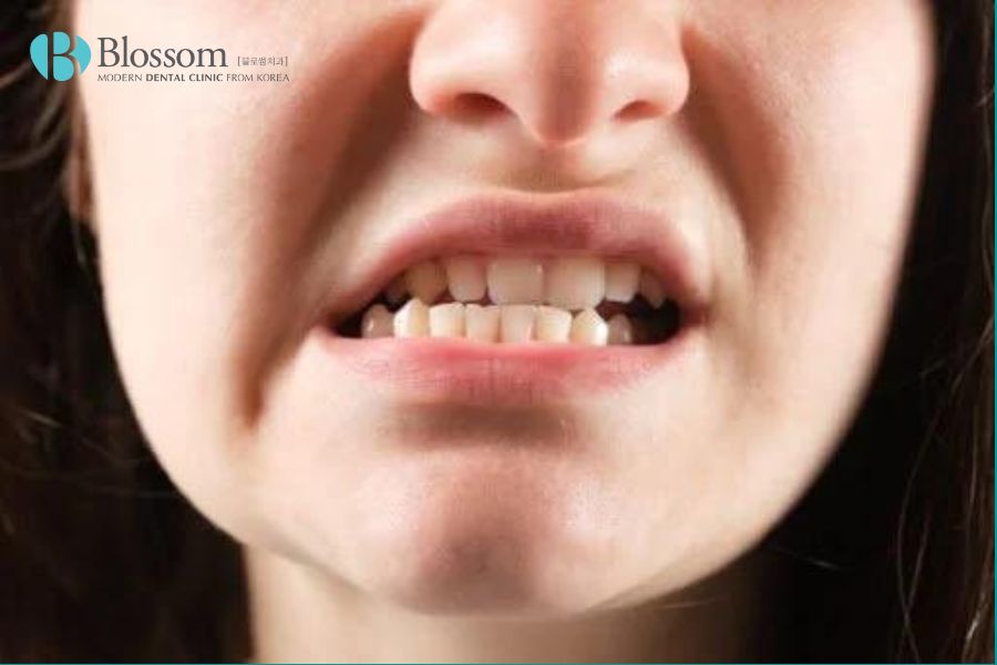 Móm hàm là tình trạng hàm dưới nhô ra ngoài hoặc hàm trên lùi vào trong.
