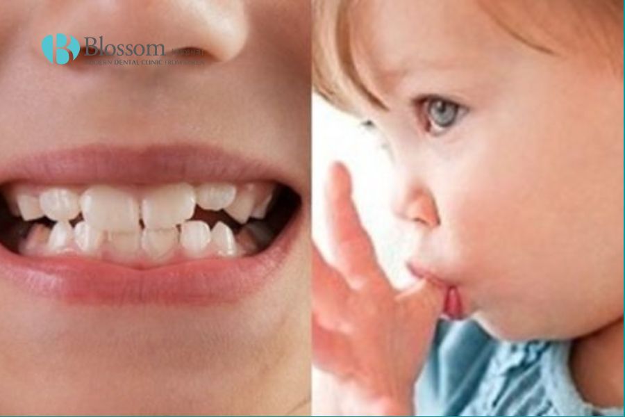 Một số thói quen xấu dẫn đến tình trạng sai lệch khớp cắn và móm răng.