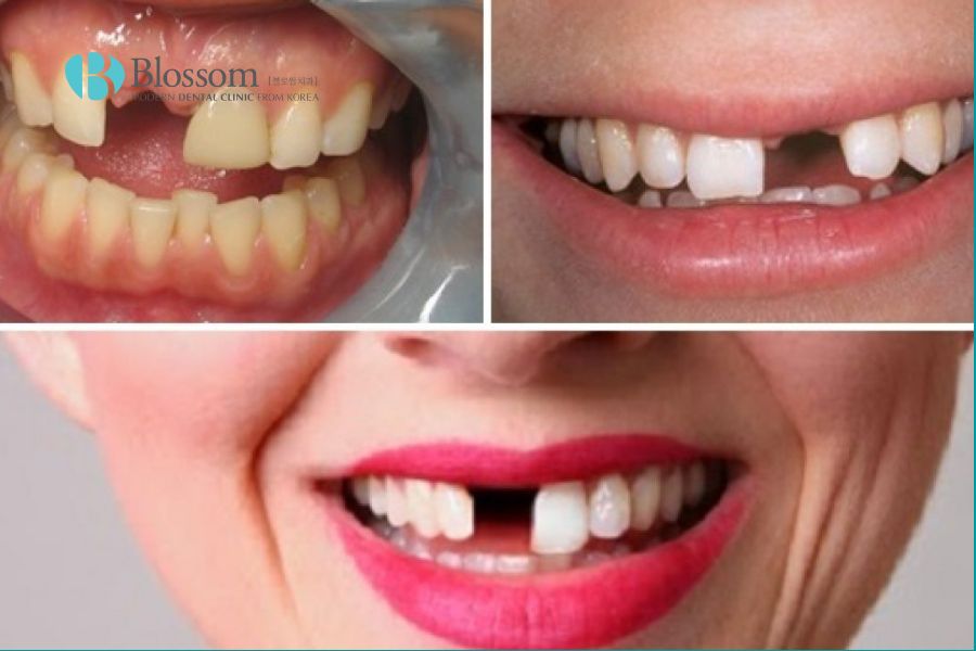Một số trường hợp mà bạn nên trồng răng vĩnh viễn