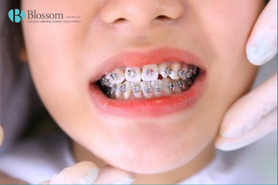 Nắn chỉnh hoặc phẫu thuật hàm là phương pháp điều trị hiệu quả cho trường hợp răng vẩu nặng.
