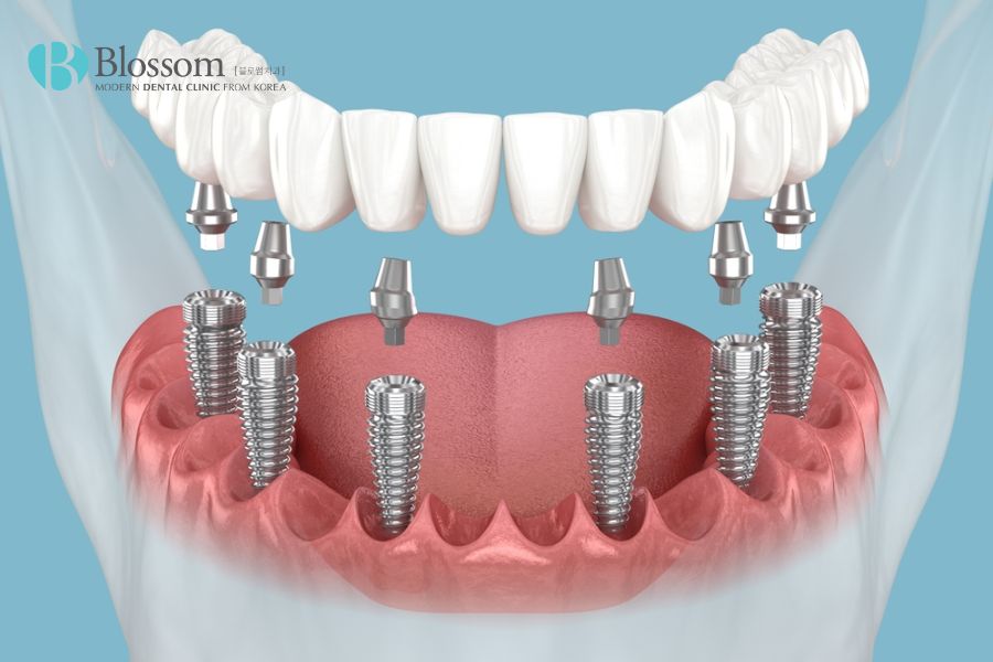 Nên thực hiện trồng răng Implant sớm nhất có thể sau khi bị mất răng