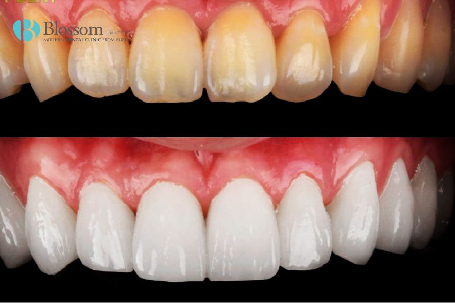 Ngày càng có nhiều người muốn lựa chọn phương pháp làm trắng răng với dán/bọc răng sứ.
