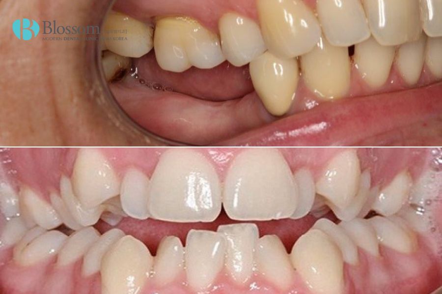 Người lớn tuổi mất răng dễ gây ra tình trạng tiêu xương hàm, xô lệch răng,...