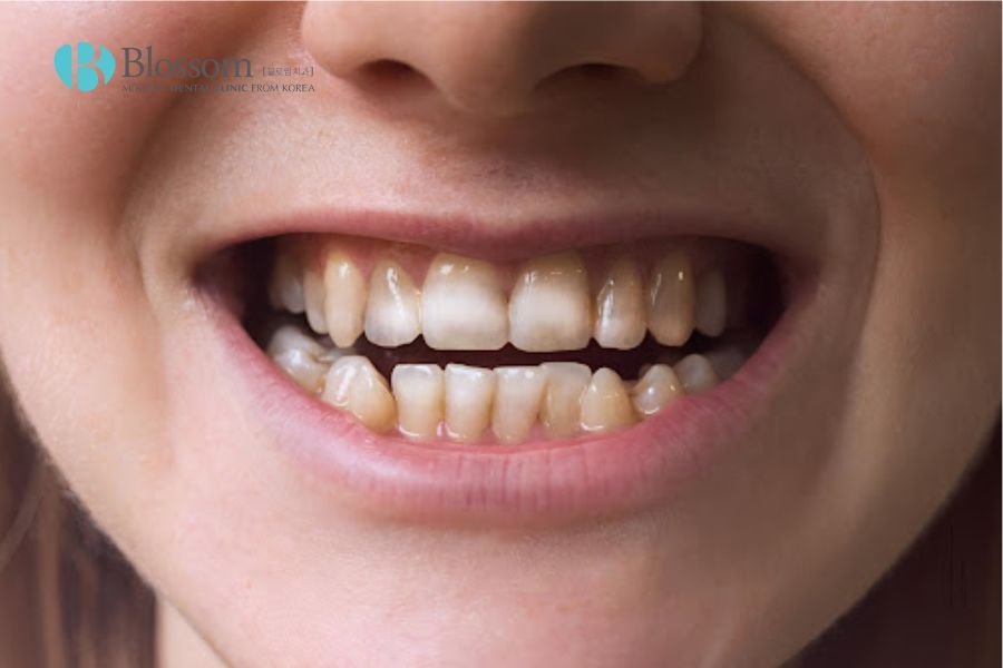 Người thiếu hụt Canxi có thể khiến men răng bị ăn mòn.