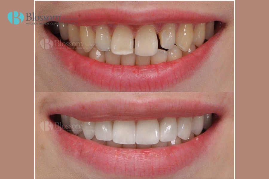 Nha Khoa Blossom cung cấp dịch vụ dán sứ Lamifilm không mài an toàn, không gây tình trạng đau răng