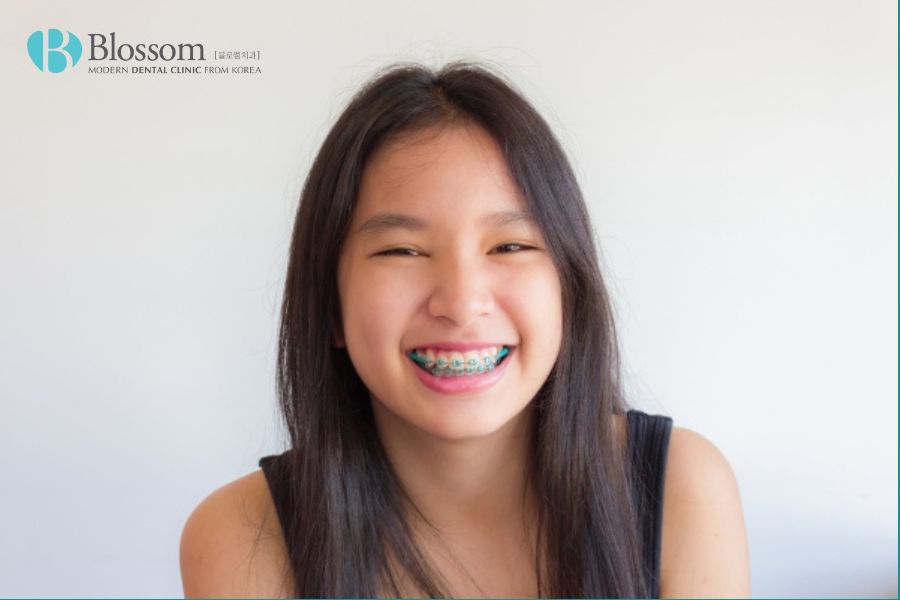 Nha Khoa Blossom là địa chỉ nha khoa uy tín giúp bạn cải thiện răng móm hiệu quả và an toàn.