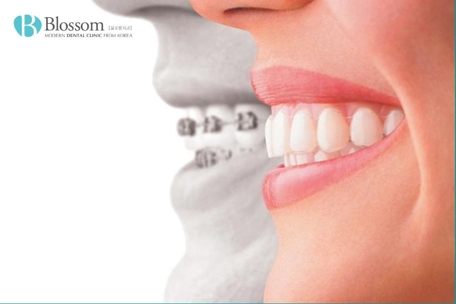 Nha Khoa Blossom là một địa chỉ uy tín và tin cậy để khắc phục tình trạng răng vẩu.