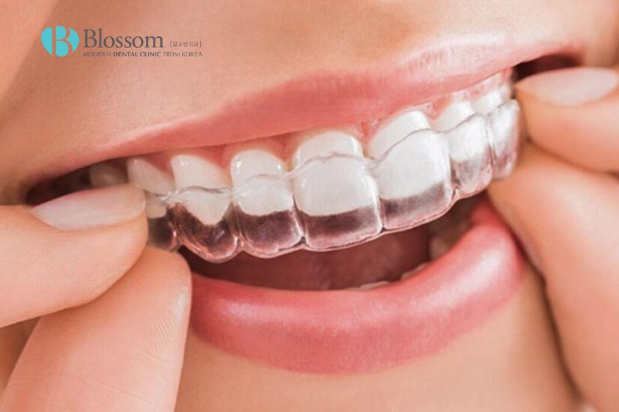 Niềng răng Invisalign là công nghệ niềng mới nhất hiện nay.
