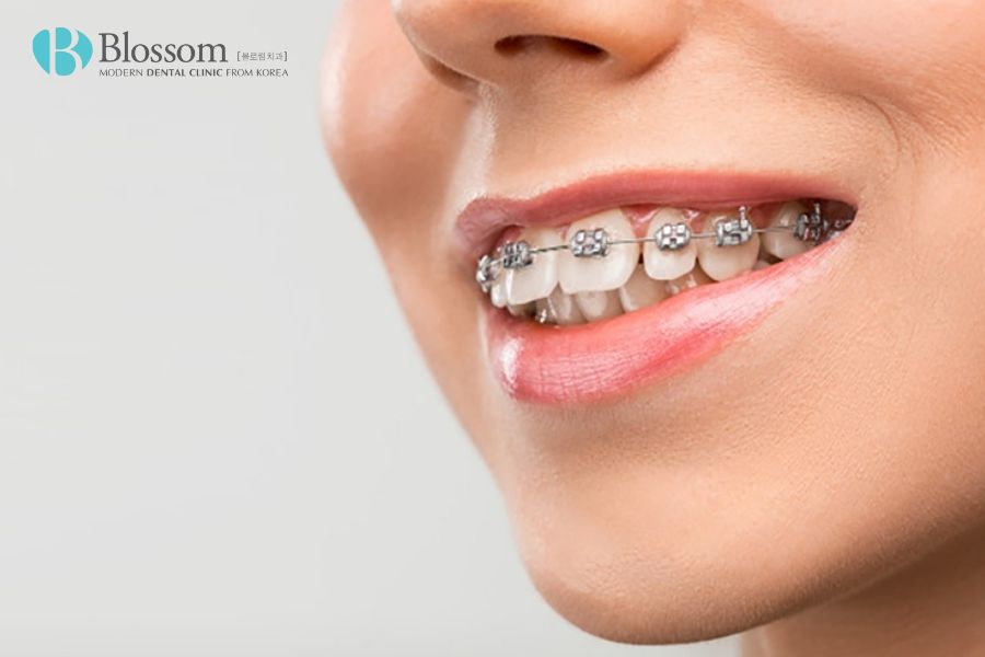 Niềng răng là giải pháp điều trị răng lệch cung hàm hiệu quả hàng đầu.