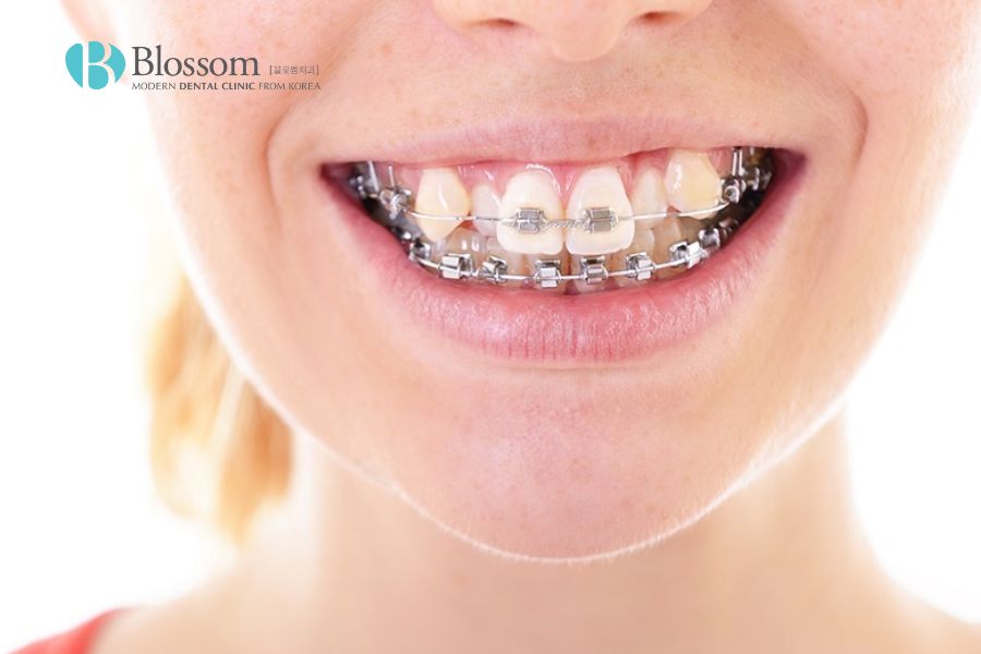 Niềng răng là giải pháp giúp cải thiện tình trạng răng khểnh rất hiệu quả.
