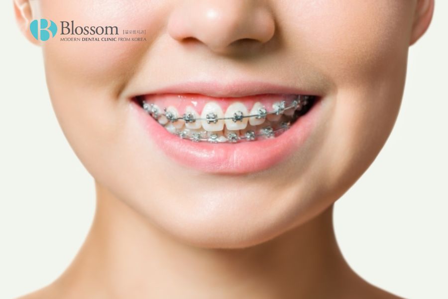 Niềng răng là phương pháp nắn chỉnh nha khoa tương đối hiệu quả với răng lệch nhẹ.