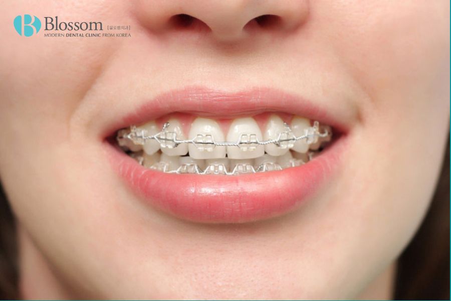 Niềng răng là phương pháp phổ biến và hiệu quả nhất để điều trị răng móm ở mọi lứa tuổi.