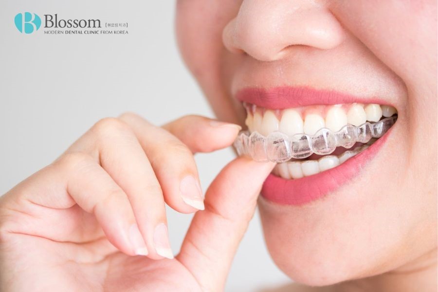 Niềng răng trong suốt là phương pháp cải thiện răng thưa tương đối hiệu quả lại có tính thẩm mỹ cao