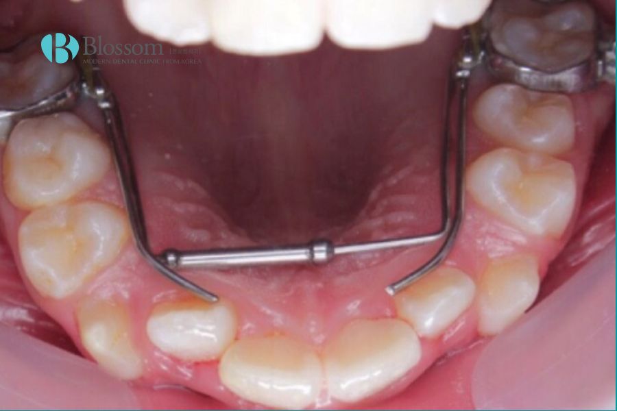 Nong hàm sẽ giúp tạo thêm khoảng trống để các răng di chuyển về vị trí mong muốn.