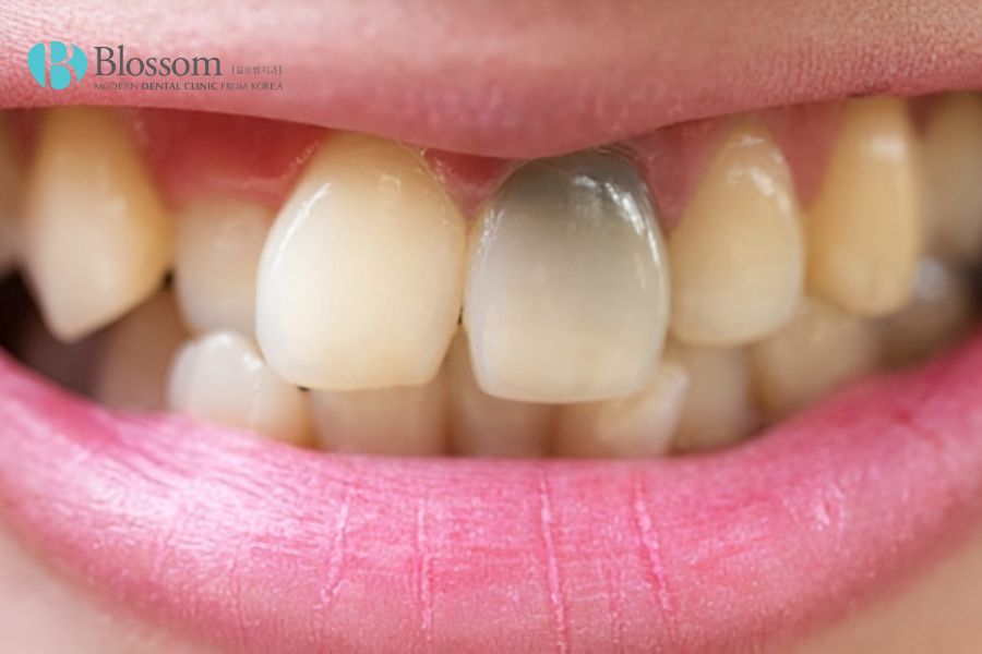 Răng bị chết tủy cũng là vấn đề bất thường sau khi bọc răng sứ