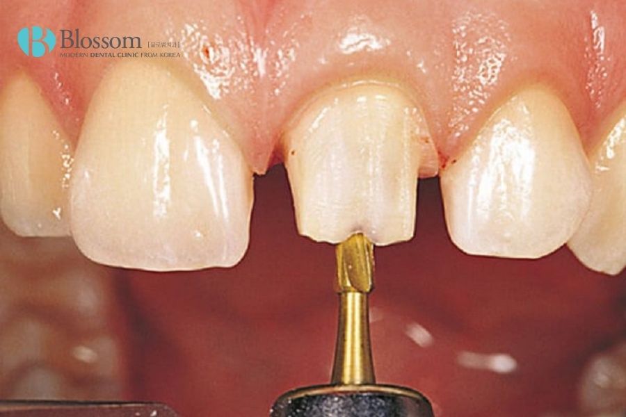 Răng bị đau sau khi gắn răng sứ có thể do tỷ lệ mài răng không đạt chuẩn