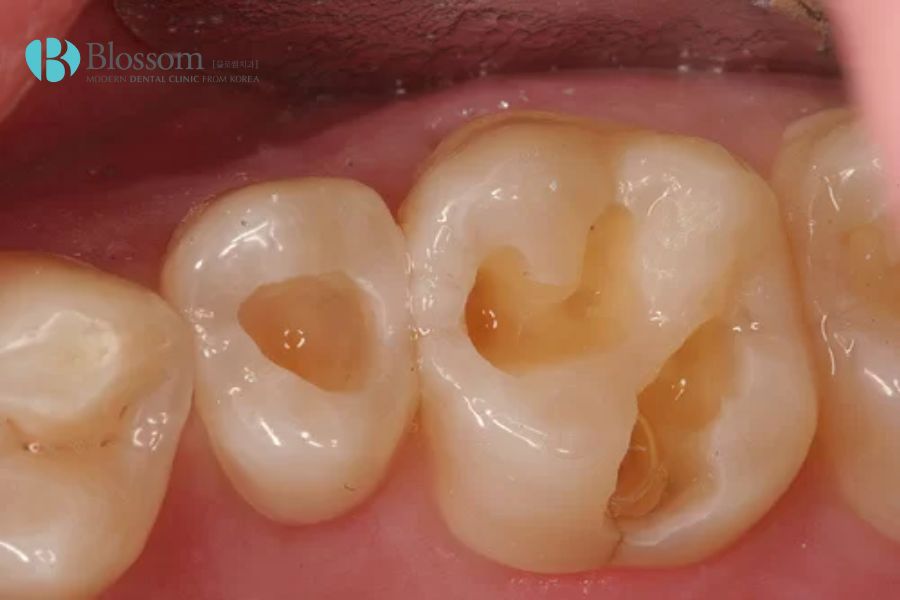 Răng bị sâu lớn có thể cân nhắc việc bọc răng sứ Titan