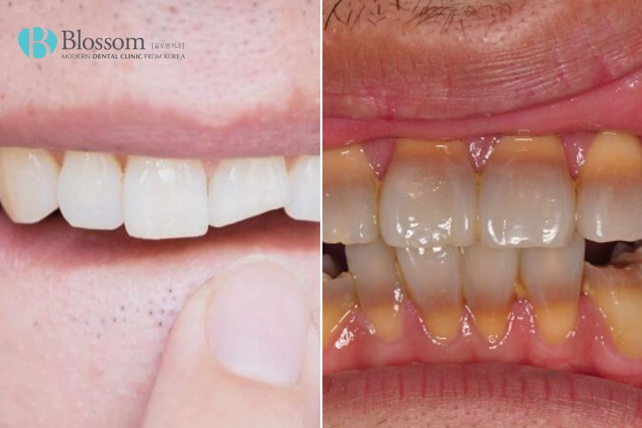 Răng bị sứt mẻ, nhiễm Tetracycline nặng nên thực hiện trồng răng sứ